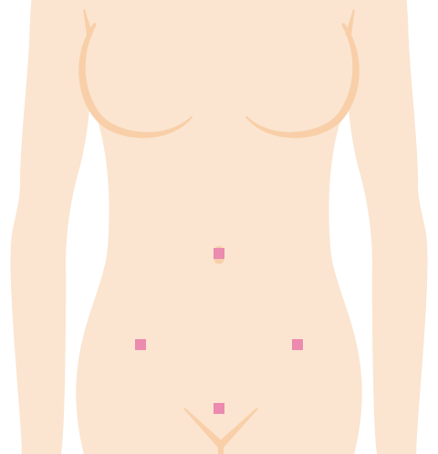 腹腔鏡手術